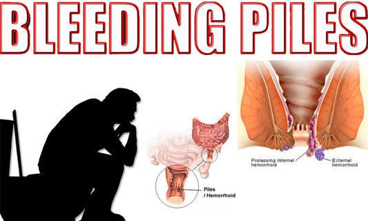 Ayurvedic Remedies For Bleeding Piles