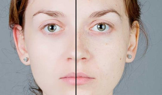 Top Ayurvedic Face Pack Brands For Blemishes