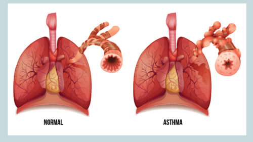 Ayurvedic Medicines For Bronchial Asthma