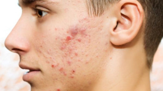 How To Get Rid Of Blemishes Naturally
