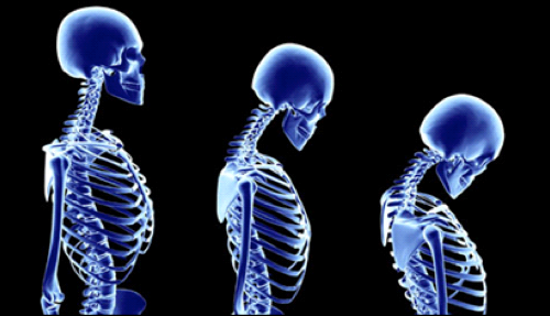 Ayurvedic Medicines For Osteoporosis