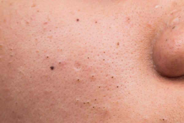 Top Face Packs For Removing Blackheads