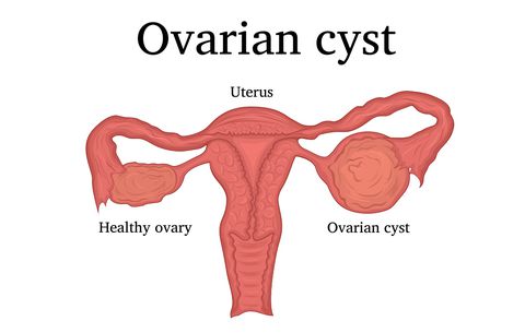 Top Natural Ways To Treat Ovarian Cysts