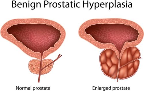 What Is Prostate Gland Enlargement