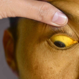 JAUNDICE