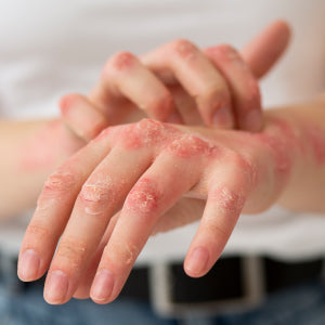 SKIN ALLERGY