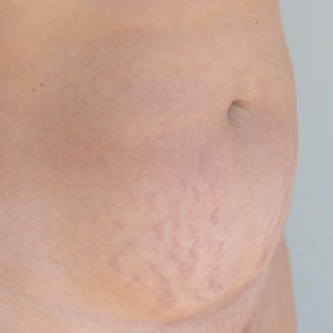 STRECH MARKS